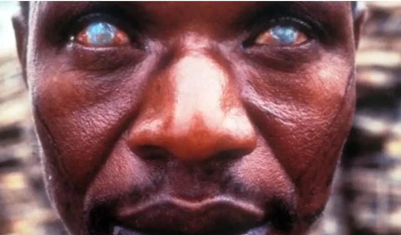 Onchocercose au Cameroun : la Moxidectine testée dans 3 districts de santé